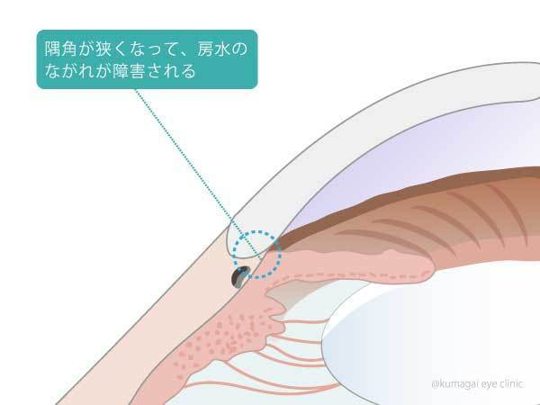 閉塞隅角緑内障の説明イラスト