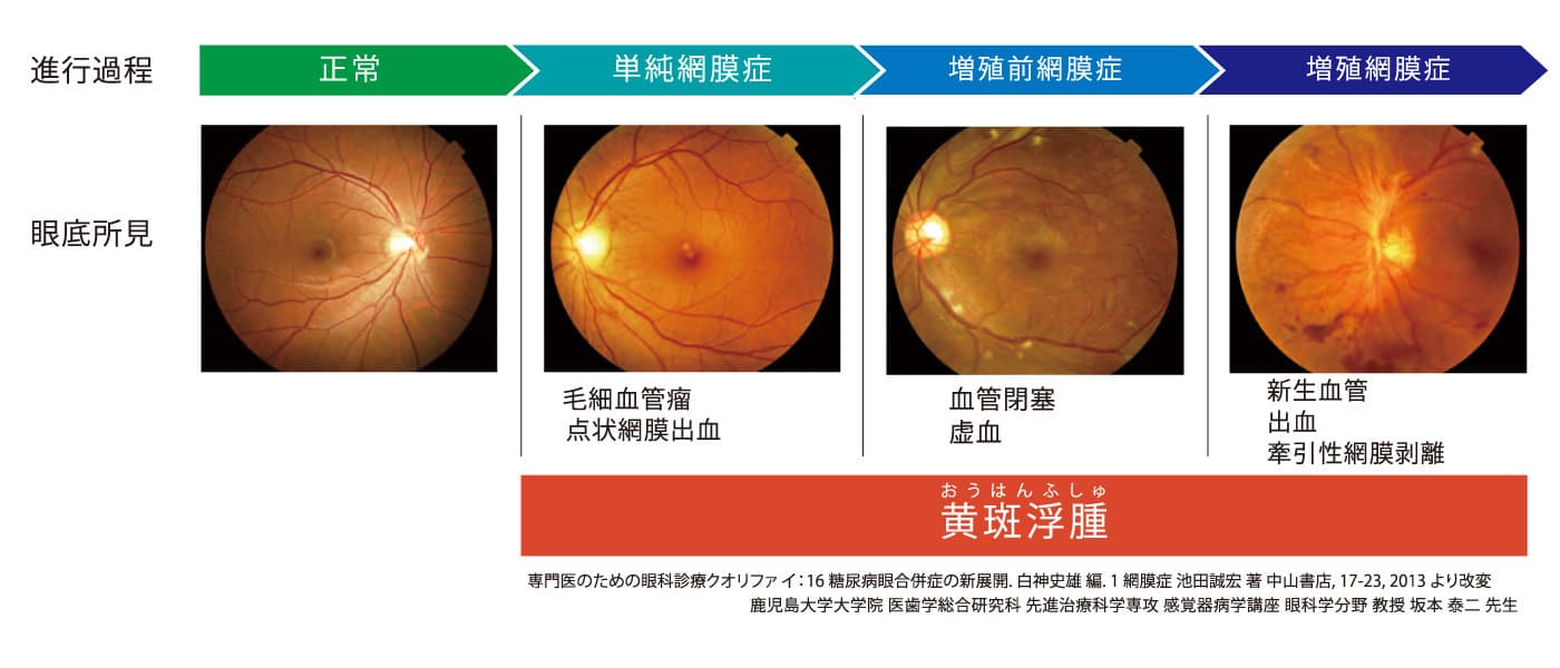 糖尿病網膜症の進行に伴う眼底写真の変化。正常、単純網膜症、増殖前網膜症、増殖網膜症の4段階と、黄斑浮腫の状態を比較